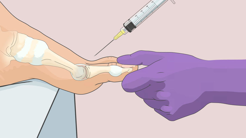 1st MTP Joint Injection